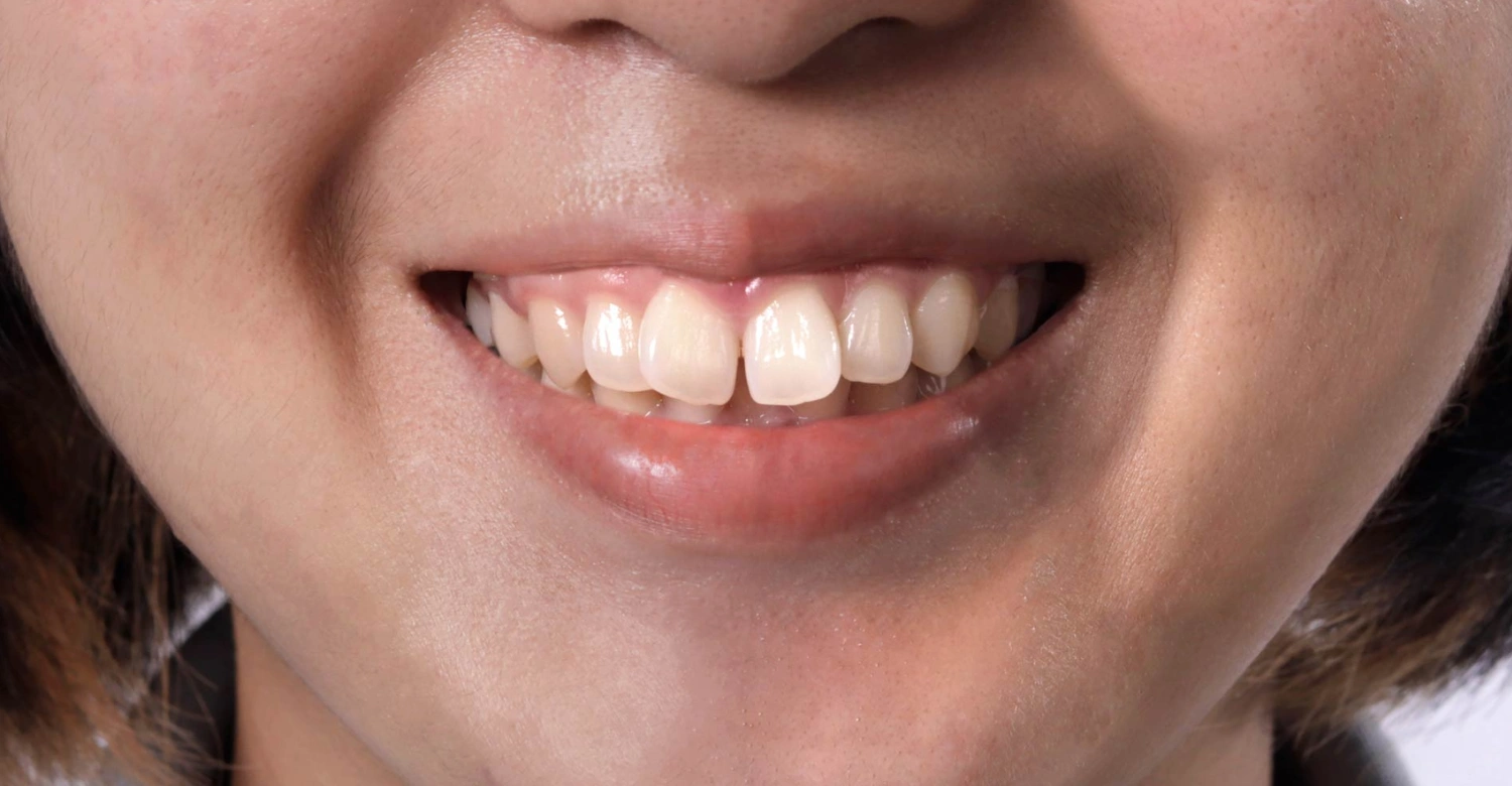 dents en avant in blog